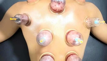Bekam Terapi Sunnah (Cupping Therapy) - Lot 1287