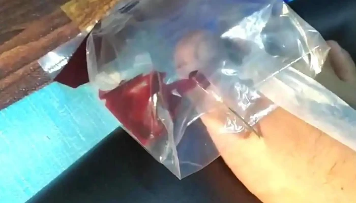 Bekam Urutan Resdung Terapi Tulang Saraf Al Fashdu By Sena Wellness Centre Video - Kangar